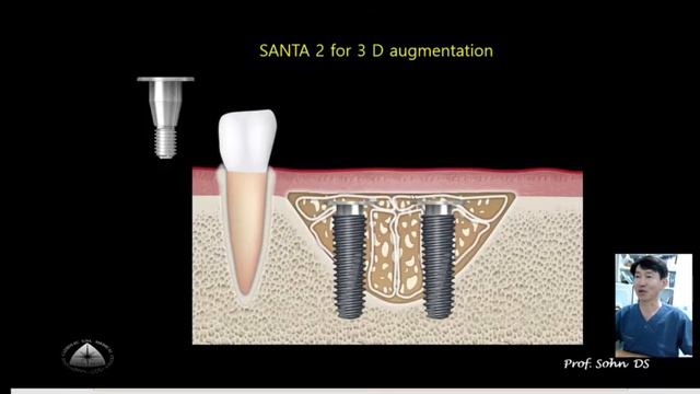 SANTA — новый тентовый абатмент